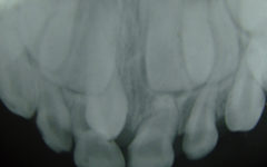 Полиодонтия у человека - рентгеновский снимок зубов