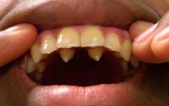 Полиодонтия передних зубов (клыки)