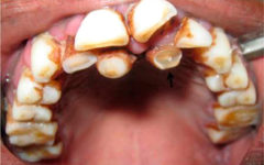Полиодонтия передних зубов