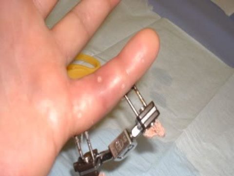 Лечение короткопалости с помощью мини-аппарата Илизарова