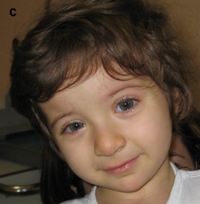 Ребенок с синдромом Рубинштейна-Тейби