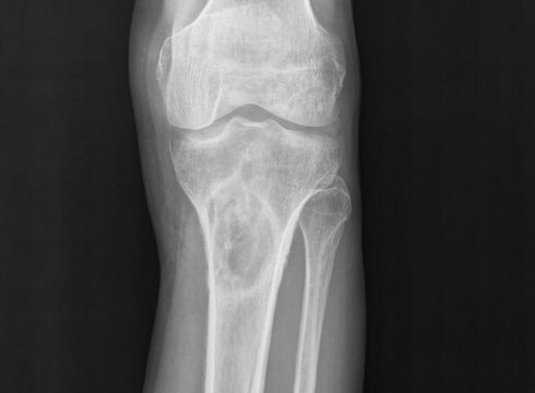 Рентгенографический снимок коленного сустава при саркоме Юинга