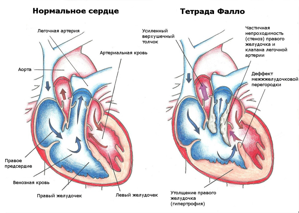 Диаграмма здорового сердца и сердца с тетрадой Фалло