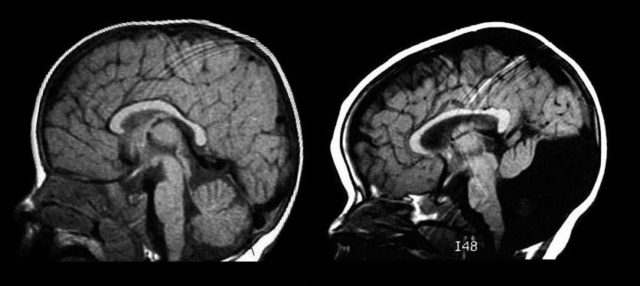 Томограмма головного мозга в норме (слева) и при синдроме Денди – Уокера (справа)