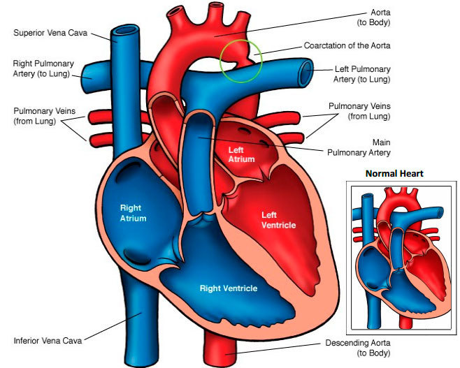 Диаграмма сердца человека с коарктацией аорты