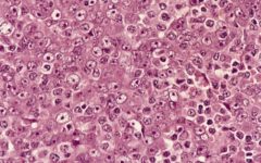 Назофарингеальная карцинома (рак носоглотки) - метастазы в лимфоузлах