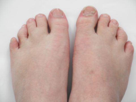 Синдром Смита — Лемли — Опица: синдактилия пальцев ног