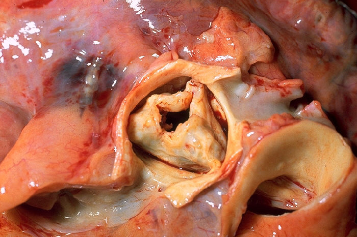 Стеноз аортального клапана, вызванный острой ревматической лихорадкой.