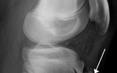 Рентгенограмма коленного сустава при болезни Шляттера