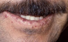 Телеангиэктазии на губах при наследственной форме болезни Рандю — Ослера.