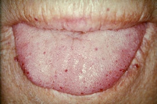 Телеангиэктазии на губах при начальной стадии синдрома Ослера
