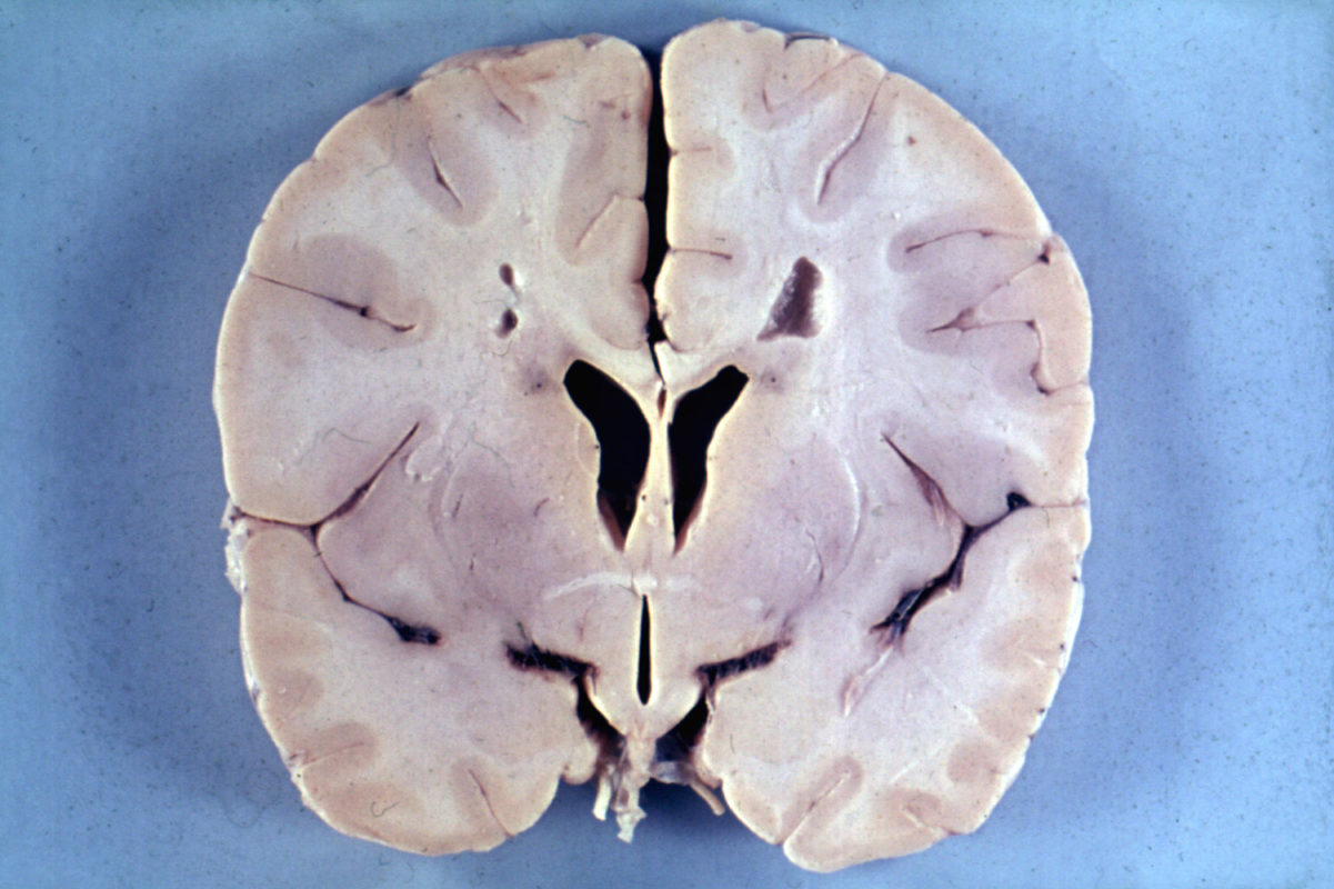 Мозг 4-летнего мальчика с болезнью Александра, наглядно демонстрирующий микроцефалию и перивентрикулярную лейкомаляцию (обратите внимание на фон вокруг желудочков мозга).