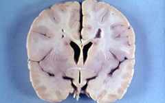 Мозг 4-летнего мальчика с болезнью Александра, наглядно демонстрирующий микроцефалию и перивентрикулярную лейкомаляцию (обратите внимание на фон вокруг желудочков мозга).