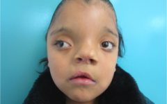 13-летняя девочка, страдающая гипертелоризмом глаз