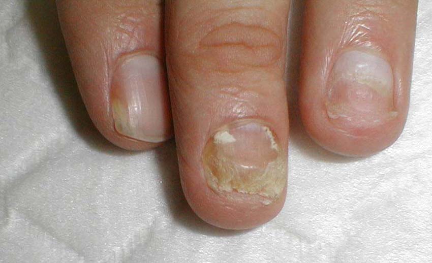 Онихолизис ногтей указательного, среднего и безымянного пальцев