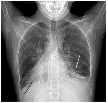 Рентгенография легких при синдроме Картагенера