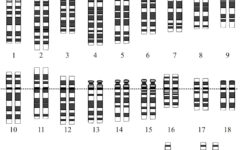 Хромосомы при синдроме Дауна - наиболее распространенном заболевании, вызванным анеуплоидией. Обратите внимание на три копии хромосомы 21 в последней строке.