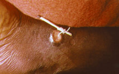 Дракункулёз (ришта): удаление червя при помощи спички