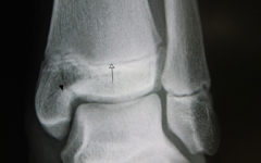 Рентгеновский снимок голеностопного сустава с эпифизеолизом медиальной лодыжки. Черная стрелка - линия перелома, белая указывает на ростковую зону.