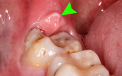 Перикоронит: поражение десны в правом нижнем углу возле третьего моляра (зуба мудрости)