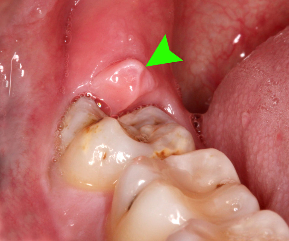 Перикоронит: поражение десны в правом нижнем углу возле третьего моляра (зуба мудрости)