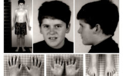 Проявление синдрома Прадера — Вилли в 15-летнем возрасте в виде отсутствия типичных черт лица и наличия мягкого стволового ожирения.