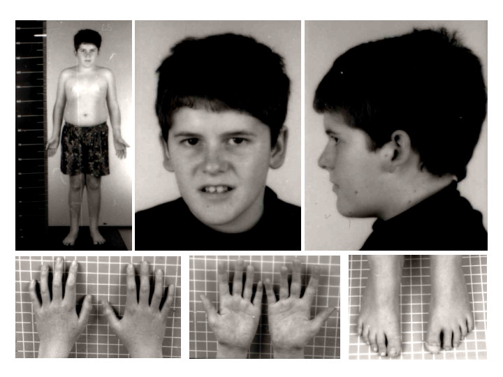 Проявление синдрома Прадера — Вилли в 15-летнем возрасте в виде отсутствия типичных черт лица и наличия мягкого стволового ожирения.