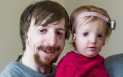Отец и дочь с синдромом Тричера Коллинза