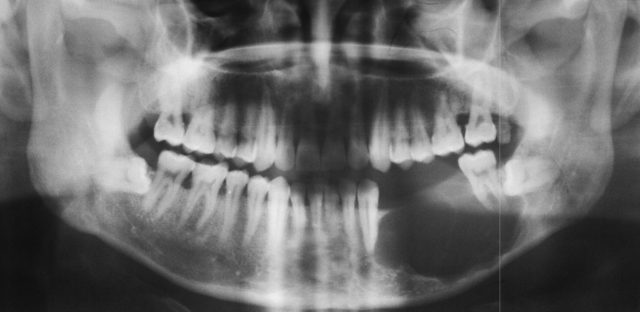 Рентгенографический снимок челюсти при амелобластоме