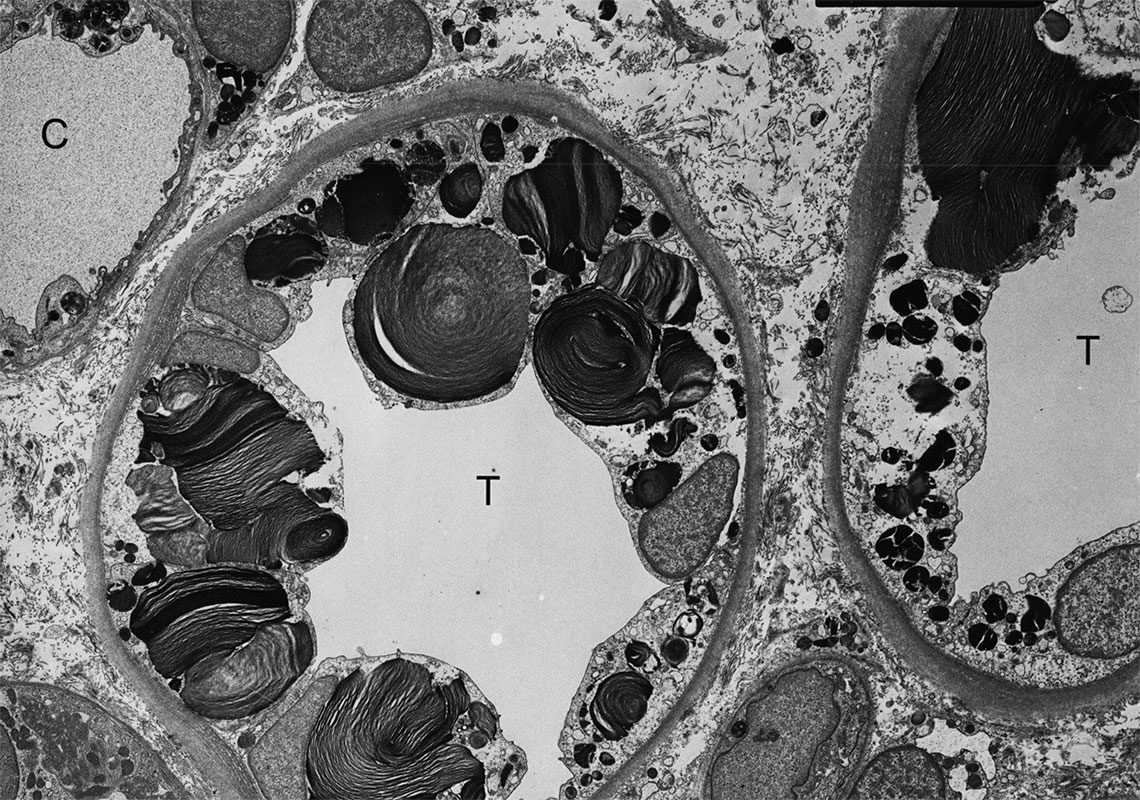 ТЭМ-микроскопия показывает наличие включений гликосфинголипидов различной формы и размеров в клетках дистальных канальцев почки.