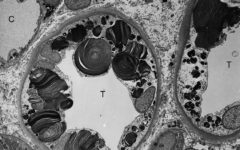 ТЭМ-микроскопия показывает наличие включений гликосфинголипидов различной формы и размеров в клетках дистальных канальцев почки.