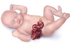 Новорожденный с гастрошизисом