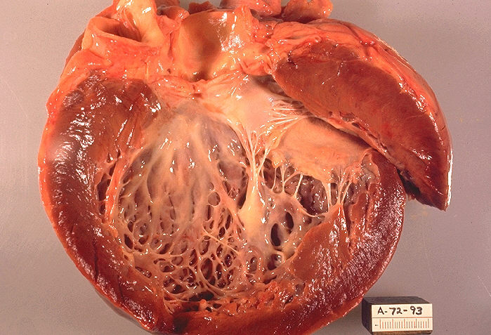 Сердце человека с кардиомиопатией