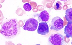 Миелоидные клетки крови при мегалобластной анемии