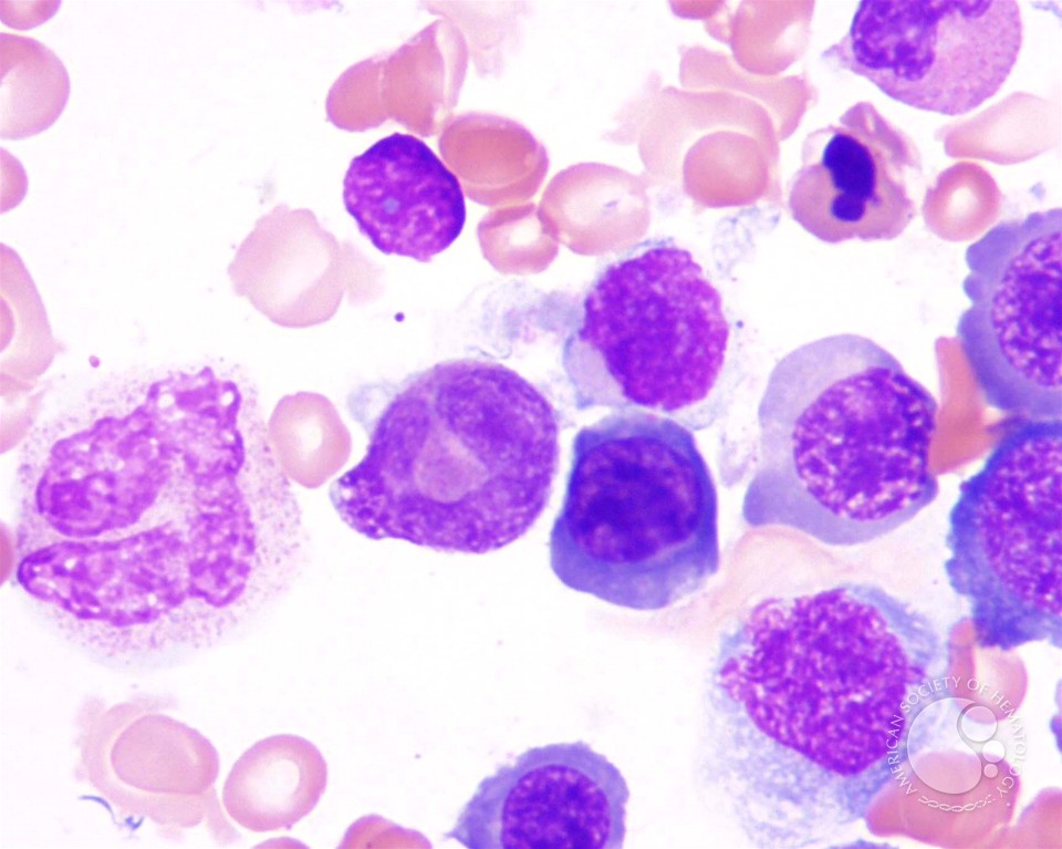 Миелоидные клетки крови при мегалобластной анемии