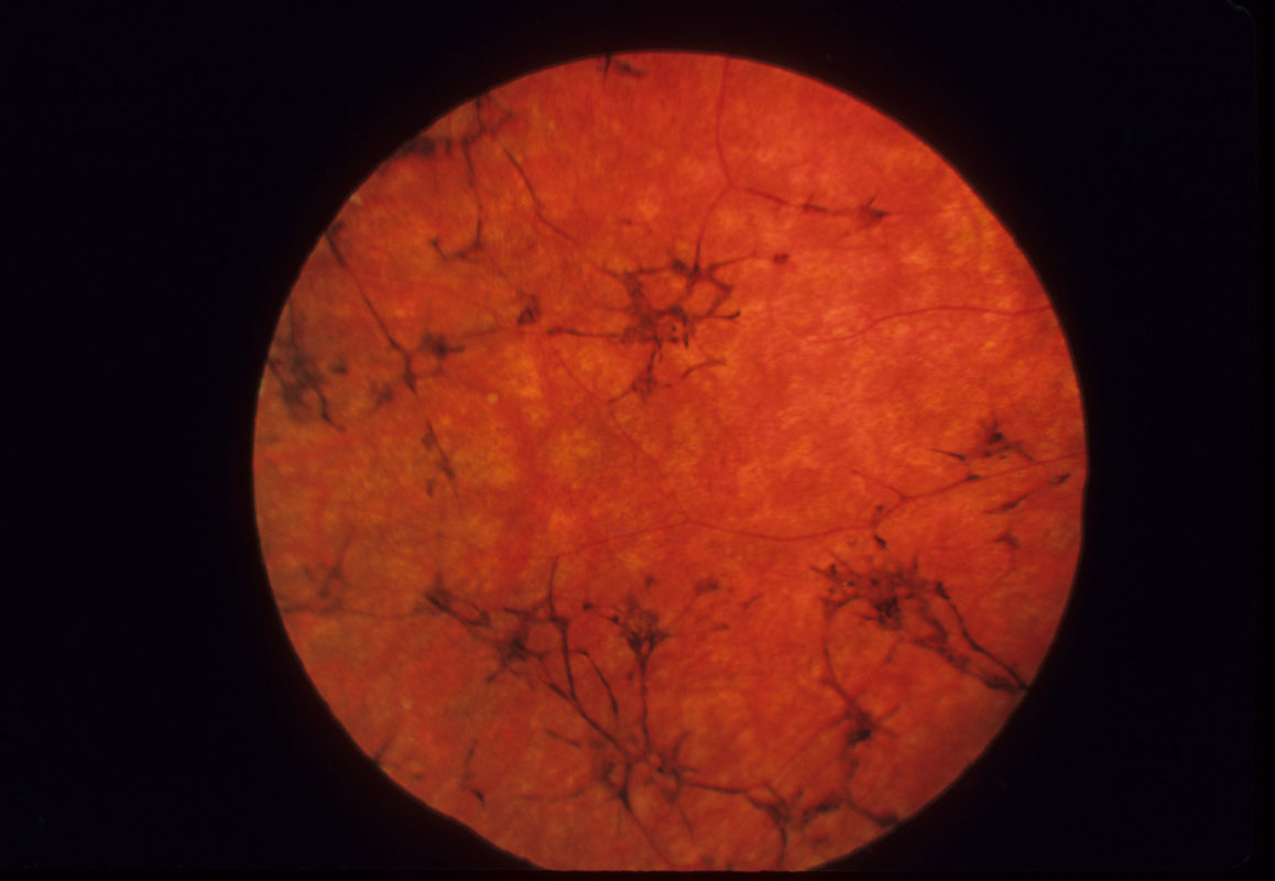 Пигментный ретинит при синдроме Ашера