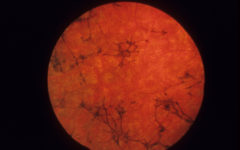 Пигментный ретинит при синдроме Ашера