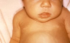 Физиологическая желтуха у новорождённого