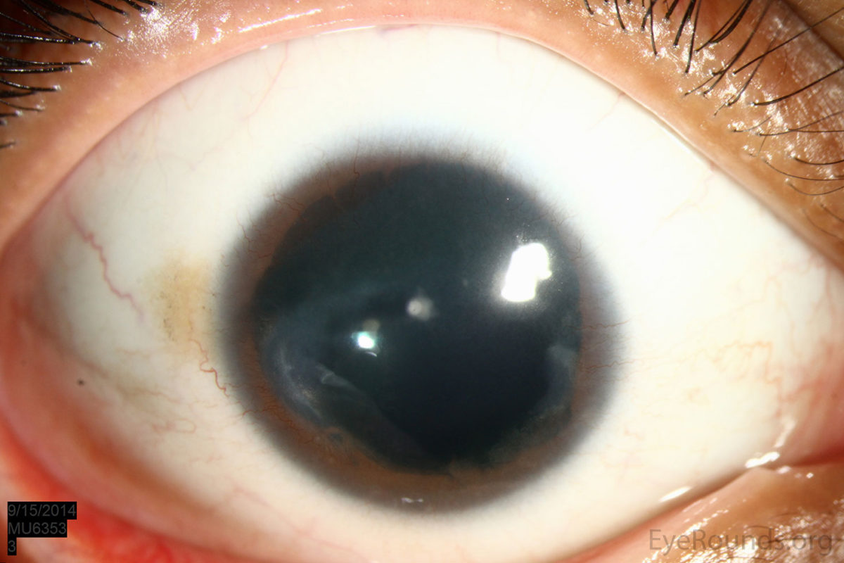Фото глаза человека с аниридией