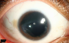 Фото глаза человека с аниридией