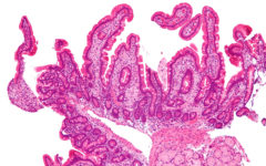 Микрофотография болезни Уиппла