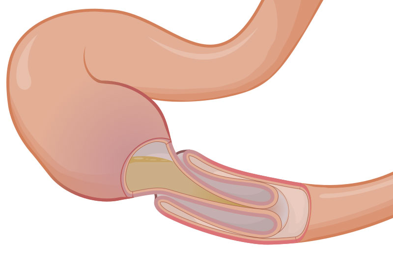 Схематическое изображение инвагинации кишечника
