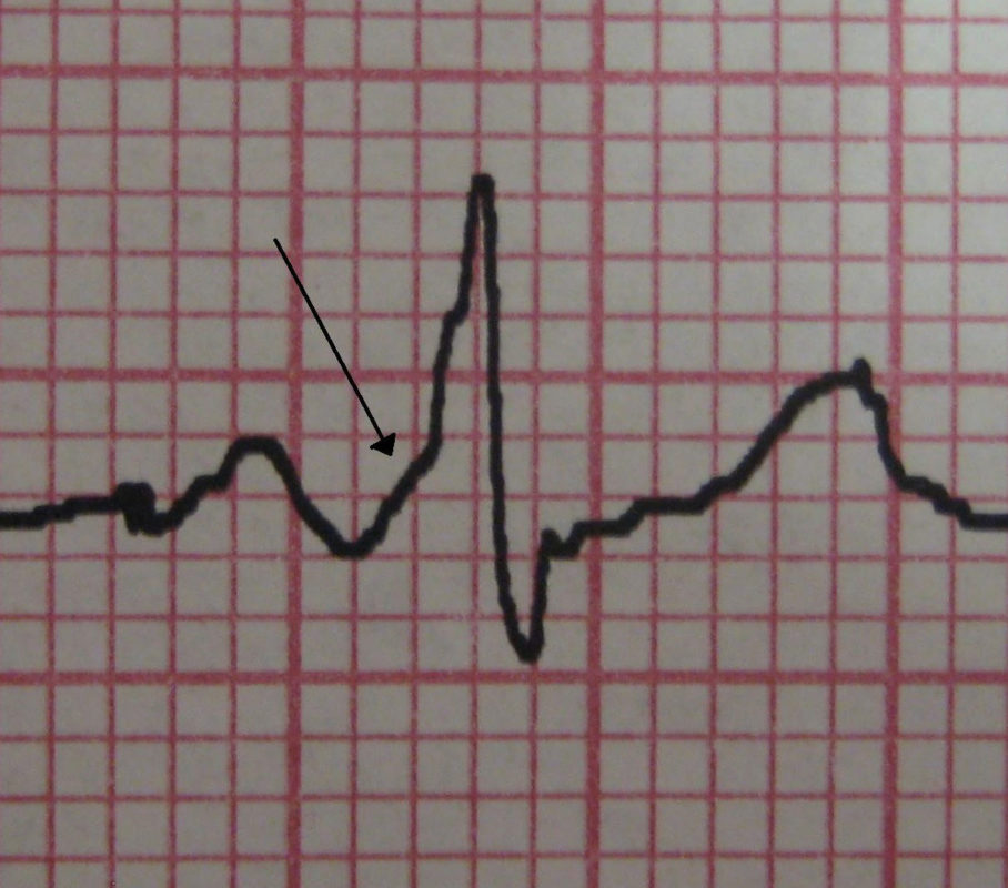 Признаки синдрома Вольфа — Паркинсона — Уайта (WPW) на кардиограмме.