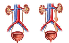 Схематическое изображение здоровой мочеполовой системы и мочеполовой системы с уретероцеле