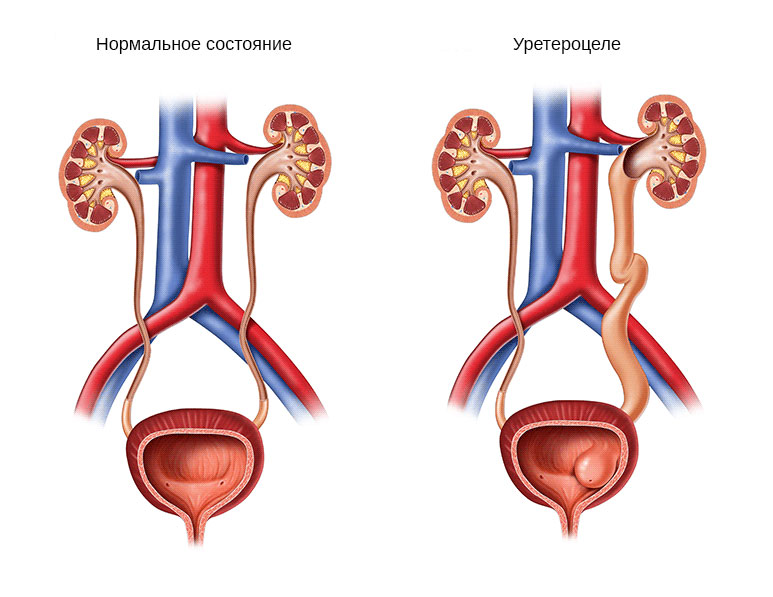 Схематическое изображение здоровой мочеполовой системы и мочеполовой системы с уретероцеле
