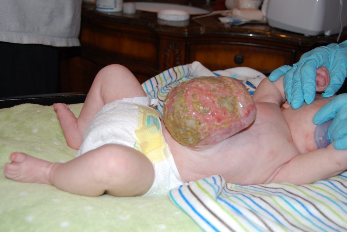 Омфалоцеле у двухмесячного ребенка (консервативное лечение)