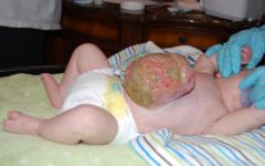 Омфалоцеле у двухмесячного ребенка (консервативное лечение)