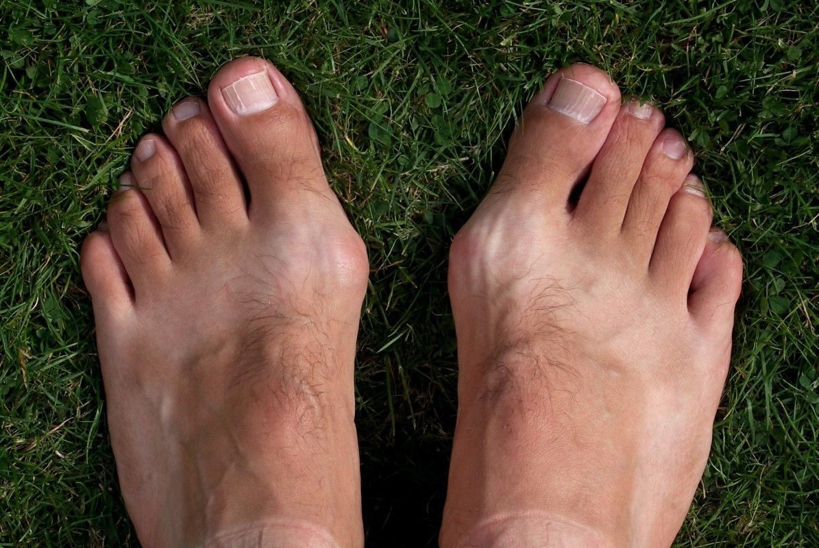 Хотя косточка на ноге считается женской проблемой, данное заболевание встречается также и у мужчин.