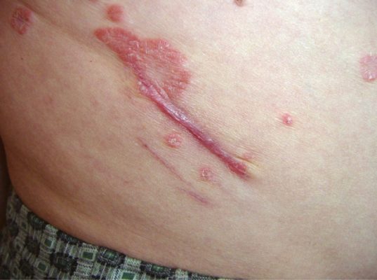 К псориатической триаде относится феномен Кебнера, при котором поражения кожи возникают на месте ее травматизации.