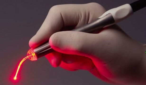 Самым малотравматичным и эффективным методом является удаление косточки на большом пальце при помощи лазера.